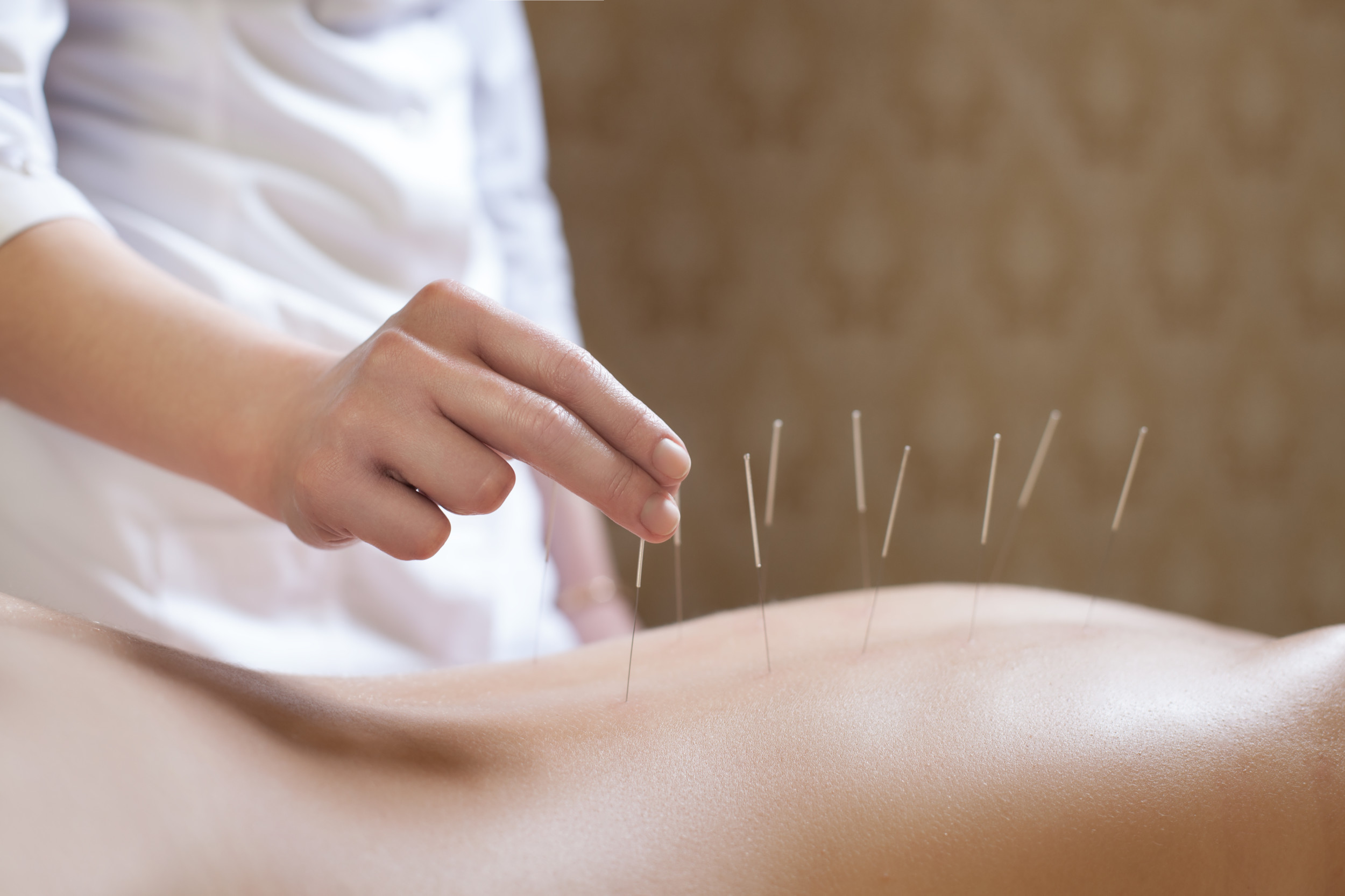acupuncturist doctor makes a therapy for woman;